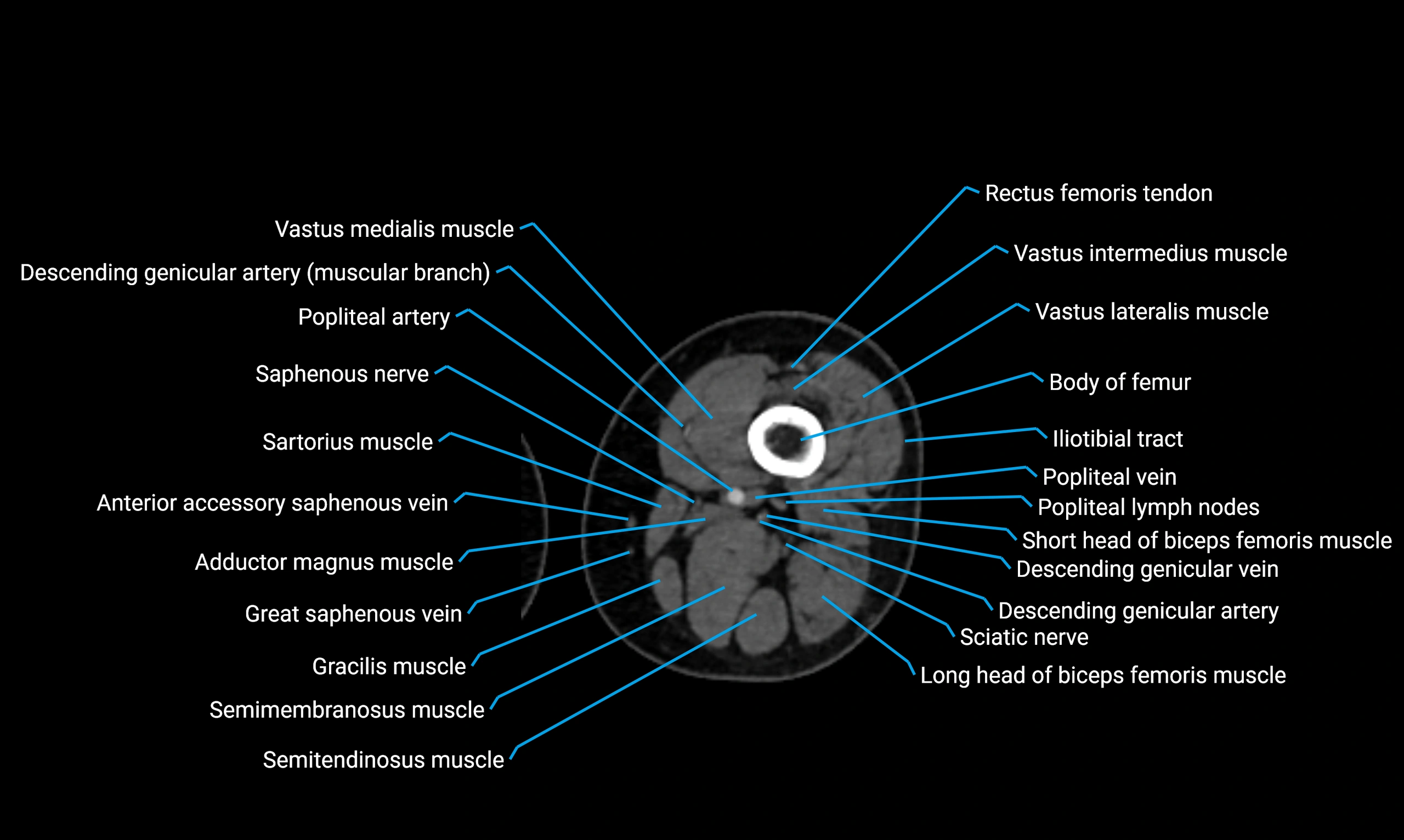 CT lower limb axial cross sectional anatomy labelled image 64 (2).webp